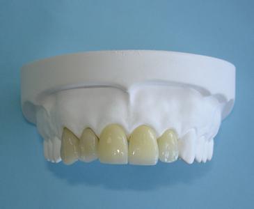 Easy the whole porcelain tooth