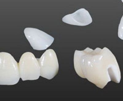 Zirconium dioxide all porcelain crown