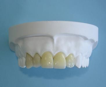 Fixed partial denture