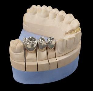 Fixed partial denture