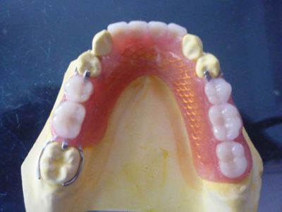 Fixed partial denture