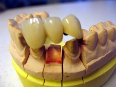 Fixed partial denture