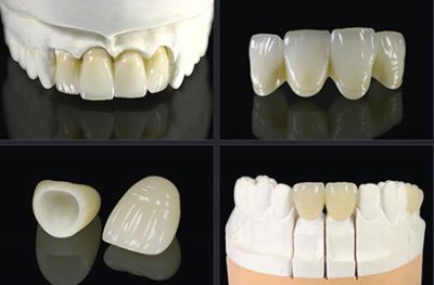 Fixed partial denture