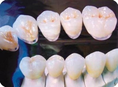 Metal nickel-chromium beryllium free porcelain teeth