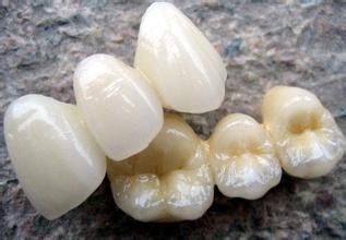 Metal nickel-chromium beryllium free porcelain teeth