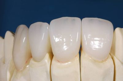 whole porcelain veneers