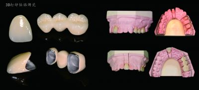 3D打印钴铬烤瓷牙